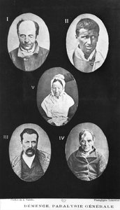 認知症、一般的な麻痺、ヘンリーダゴネット（1823-1902）、パリ、バイリエール、1876年による精神疾患の新しい基本的かつ実践的な治療からのイラスト